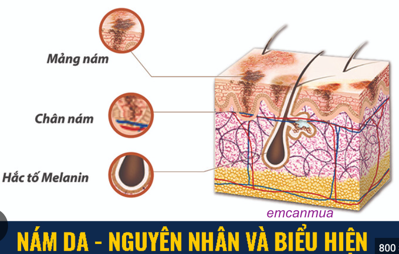 nguyen nhan va dau hieu da bi nam